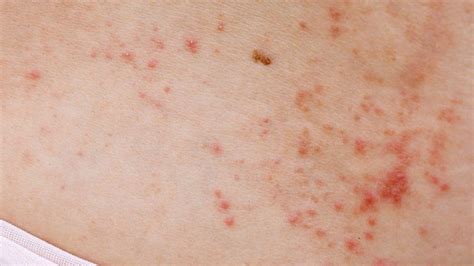 Red spots on the skin: main causes of the problem | Nxt Health