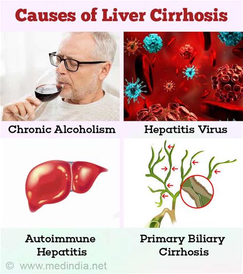 Liver Cirrhosis Causes