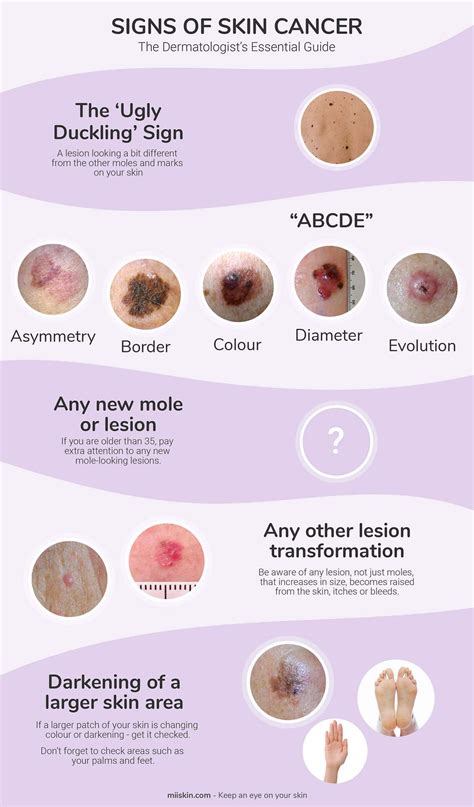 Skin Cancer Symptoms Pictures Photos Types Signs Melanoma - Riset