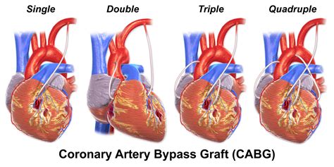 Coronary Artery Bypass Grafting (CABG) - almostadoctor