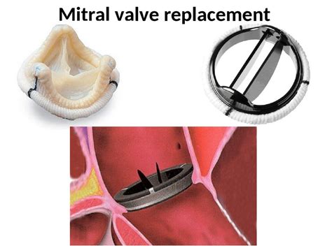 Valvular heart disease. Mitral valve - презентация онлайн