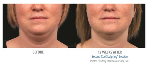 CoolSculpting Double Chin in Atlanta, GA | Sculpted Contours