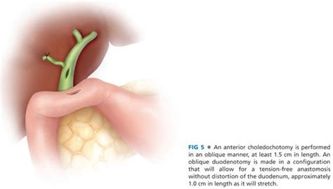 Choledochoduodenostomy | Abdominal Key