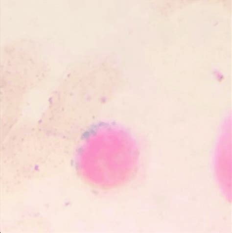 Bone marrow aspirate stained with Prussian blue, examined under ×100 ...