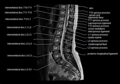 MRI Spine Anatomy | Free MRI Lumbar Spine Sagittal Cross Sectional Anatomy