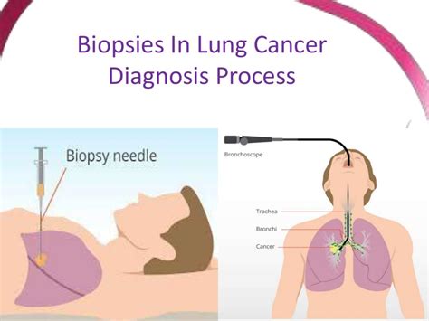 Biopsies in lung cancer diagnosis process