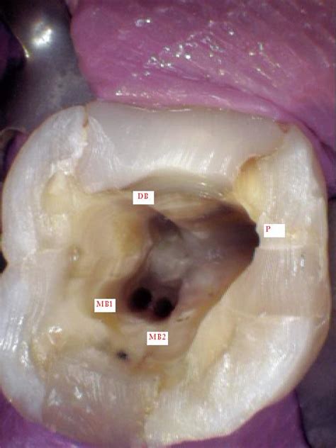 Root Canal Treatment: Locating the 4th canal in Maxillary First Molars