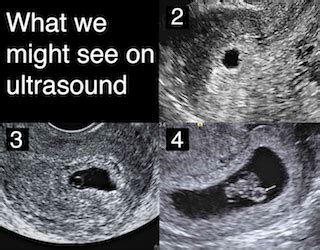 5 1 2 Weeks Pregnant Ultrasound Pictures - PictureMeta