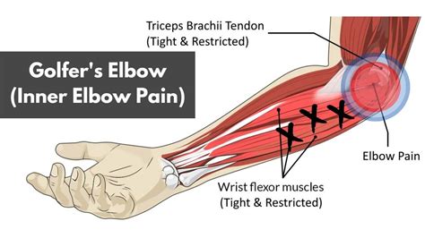 A Helpful Guide to Golfer's Elbow (Inner Elbow Pain)