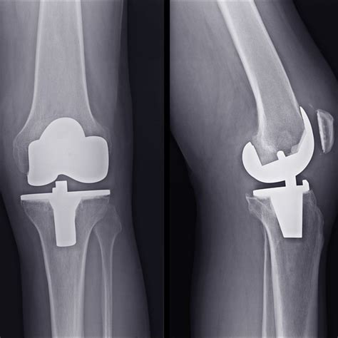 What Is Bilateral Knee Replacement Surgery? - HealthFinder