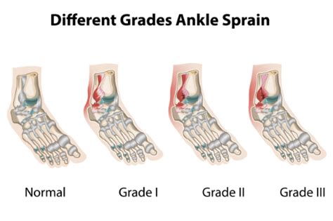 Chiropractor Conway AR - The 3 Grades of An Ankle Sprain & How ...