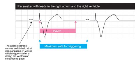 Basic cardiac pacing, pacemaker functions and settings – Cardiovascular ...