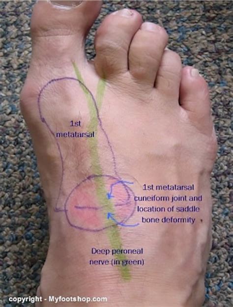 Saddle Bone Deformity | Causes and treatment options - Printer friendly ...