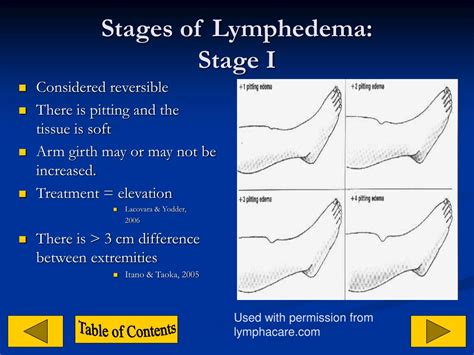 PPT - Lymphedema PowerPoint Presentation, free download - ID:1272891