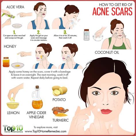 Acne - Quick Tips - MyVins my id