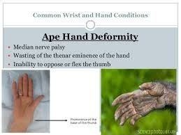 Image result for ape hand deformity | Median nerve, Nerve palsy ...