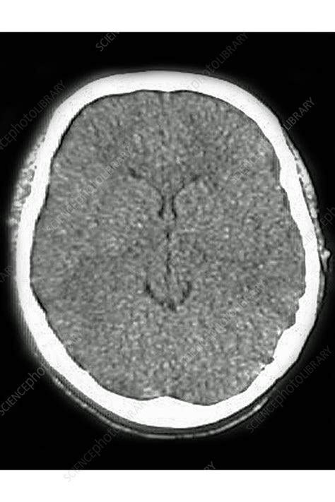 Cerebral Edema Images