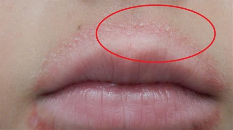 What Does An Allergic Reaction On Lips Look Like | Sitelip.org