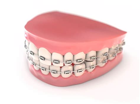 Fake teeth braces model - TurboSquid 1471661