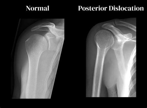 Shoulder Dislocation - A Complete Guide | Dr Mehta, San Jose