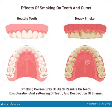 Effects of Smoking on Teeth and Gums. Oral Cavity of Heavy Smoker Stock ...