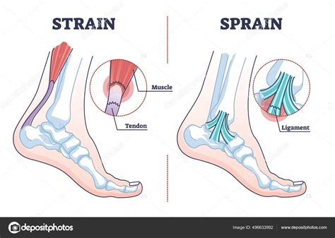 Sprain vs strain anatomical comparison as medical foot injury outline ...