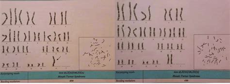 The karyotype of the reported patient with mosaic Turner syndrome ...