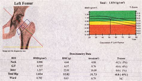 Dexa Scan Score Chart