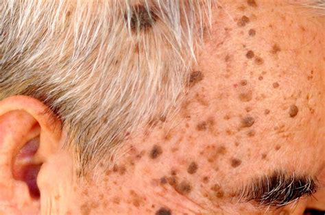 What Is Seborrheic Keratosis And Can It Be Removed?