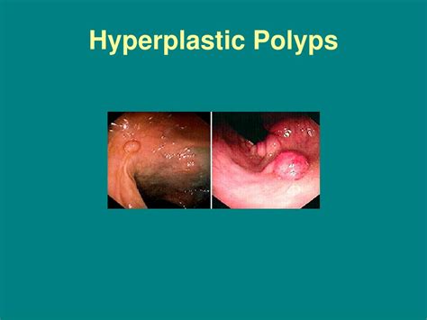 PPT - Colon Polyps PowerPoint Presentation, free download - ID:144545