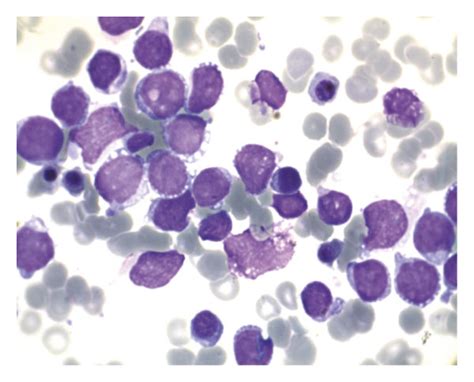 Three types of lymphoblast in acute lymphoblastic leukemia. (a) L1 ...