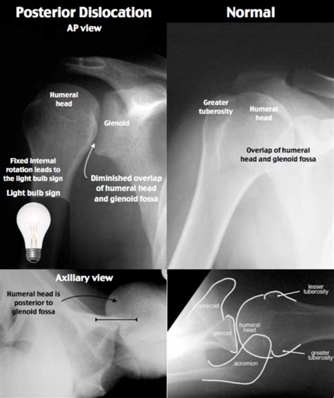 emDOCs.net – Emergency Medicine EducationEM@3AM: Posterior Shoulder ...