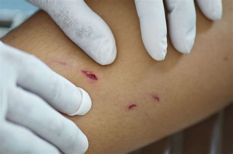 Wound Care and Treatment After a Dog or Animal Bite