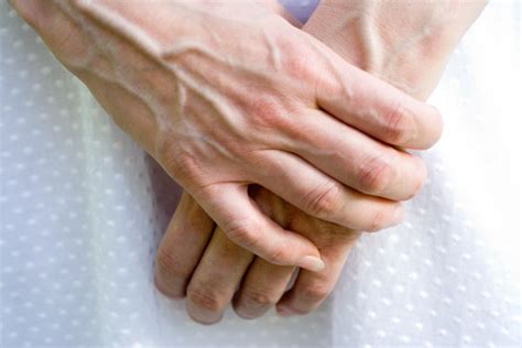 Bulging Hand Veins: Causes and Treatments | Med-Health.net