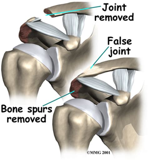 ACJ Arthritis | Brisbane Knee and Shoulder Clinic | Dr ...