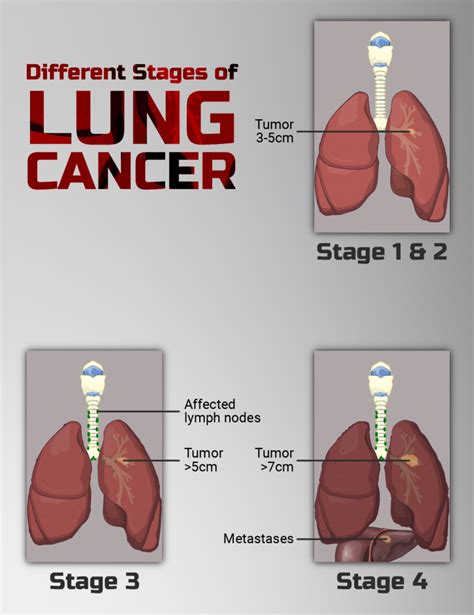 Stages Of Lung Cancer