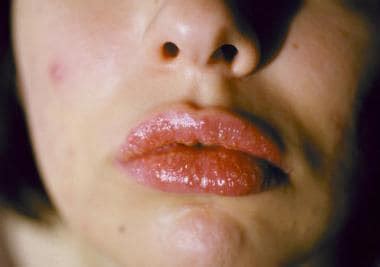 Allergic Reaction On Lips : Eczema on the lips: Types, triggers, causes ...