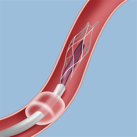 Surgery for Ischemic Stroke | Weill Cornell Brain and Spine Center