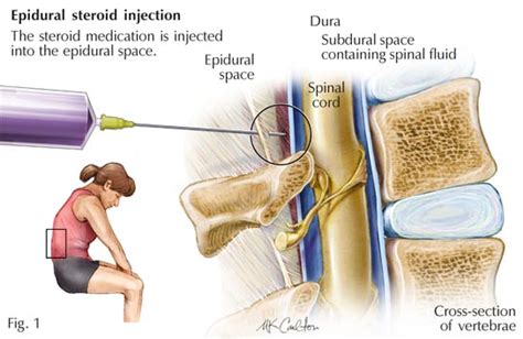 Epidural Steroid Injection