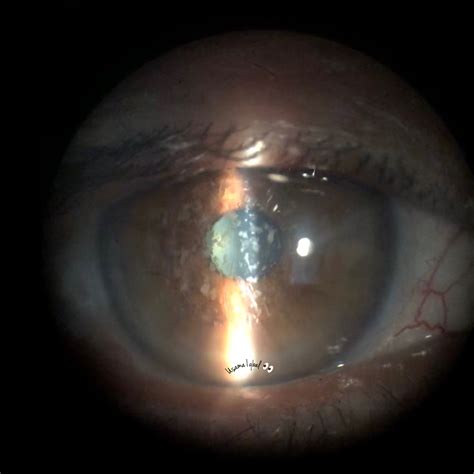 Granular corneal dystrophy - American Academy of Ophthalmology