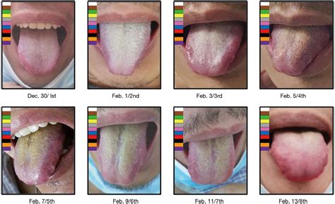 Diagnóstico y tratamiento de la lengua en la medicina tradicional china ...