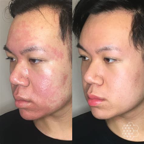 Acne Scar Treatment & Removal Vancouver BC | Skin Technique