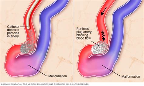 Arteriovenous Malformation (AVM) - Risks & Treatment | Neuroaxis