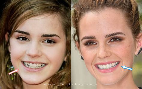 6 Celebrities Who Got Veneers: Before and After Transformations