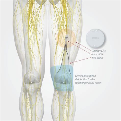 Peripheral Nerve Stimulation | Pain and Spine Specialists