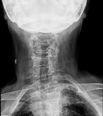 Advanced cervical spine spondylosis | Radiology Case | Radiopaedia.org