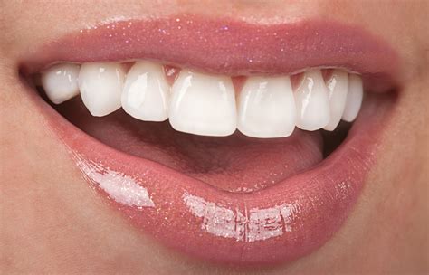 5 Things Everyone should know about Veneers - Vernon Dentist Dr. Gary ...