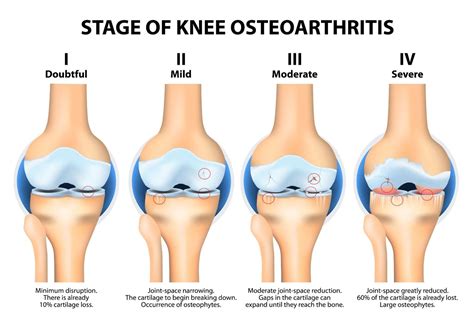 Osteoarthritis Stages Knee