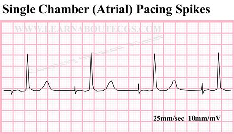 Single Chamber Atrial Pacing Spikes ECG by ELECTROCARDIOLOGY