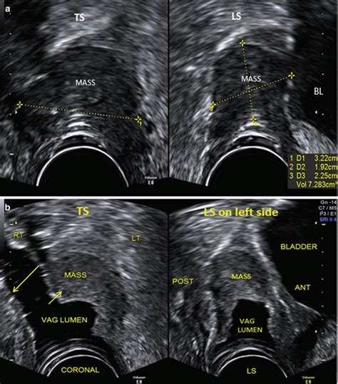 General Techniques in Gynecological Ultrasound | Obgyn Key